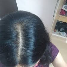 How well will the depo. What Are The Best Treatment Options For A 29 Year Old Female Suffering From Androgenetic Alopecia