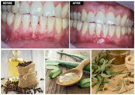Take care of your oral health between dental visits. Grow Back Your Receding Gums In No Time With The Help Of These Natural Remedies Receding Gums Gum Disease Treatment Gum Disease