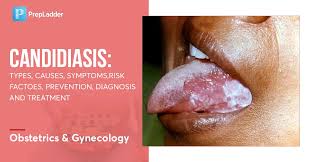 Image result for Candidiasis
