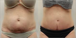 When it comes to trying to get rid of the excess skin, there are many other ways to do this if weight training isn't for you. Tummy Tuck Surgery Abdominoplasty