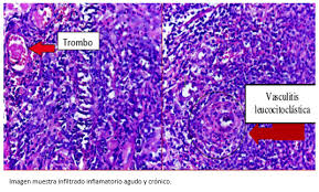 Depending on where the nerve damage occurs, ms can affect vision, sensation, coordination, movement, and bladder and bowel control. Enfermedad De Neuro Behcet En Peru Reporte De Caso Y Revision De La Literatura Medwave