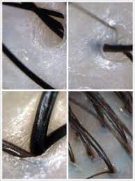 It may help restore hair growth. Scalp Treatment Kimage