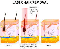Maybe you would like to learn more about one of these? Laser Hair Removal Cost Cincinnati Package Price Better Than Groupon