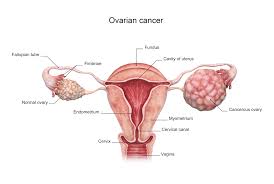 Researchers have their first real hint that there might be a way to. Ovarian Cancer Signs Symptoms And Diagnosis Saint John S Cancer Institute Santa Monica Ca