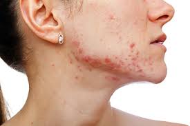 Maybe you would like to learn more about one of these? What Can Clear Severe Acne