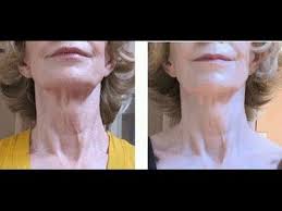 We do so much to prevent them. Face Exercises Solutions To Get Rid Of Turkey Neck And Baggy Sagging Neck Skin Sagging Neck Skin Face Exercises Turkey Neck