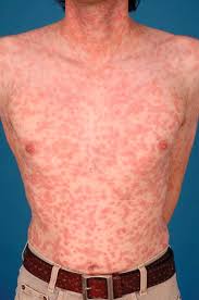 Days after the bite and include fever, headache, body aches, and sometimes a skin rash. The Rash Of Secondary Syphilis Cmaj