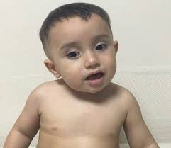 Duane retraction syndrome in a patient with abnormal head position