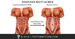 A free website study guide review that uses interactive animations to help you learn online about anatomy and physiology, human anatomy, and the human body systems. Diastasis Recti In Men The Tummy Team Online Core Rehabilitation The Tummy Team