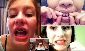 Place the braces on the teeth, centering the brackets on each tooth. Diy Braces Made With Elastic Bands Will Ruin Gums And Make Teeth Fall Out Daily Mail Online