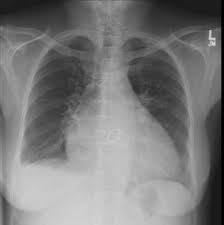 Cardiomegaly Radiology Reference Article Radiopaedia Org