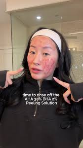 Peeling Solution Azha
