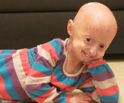 Adalia Rose The Girl With Progeria Facts Her Family Life