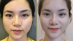 Cắt Mí Mini Deep: Giải pháp hoàn hảo cho đôi mắt một mí, sụp mí