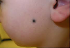 Image result for Blue Nevus