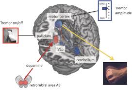 Image result for Rest Tremor