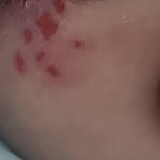 Image result for diaper dermatitis adult -children -infant -baby