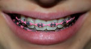 Jika dipasang di klinik kerajaan, berapakah. Pakai Braces Akhirnya