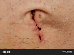 Any form of cosmetic enhancement is very personal, so prices are bespoke dependent on your individual needs. Belly Button Suture Image Photo Free Trial Bigstock