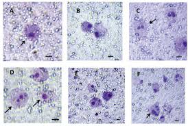 Malignant pleural mesothelioma (mpm) is an aggressive disease with very poor prognosis which tends to affect older patients. Detection And Cultivation Of Circulating Tumor Cells In Malignant Pleural Mesothelioma Anticancer Research