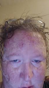 When I have my meltdowns I end up hitting my head I just had a big one I  need some suggestions in how I can help protect myself I don't have any