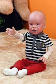 Image result for Ichthyosis