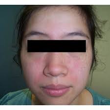 Patient presents with central facial rash 2 months after the diagnosis...