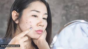 How to cover dark spots on face. Is Your Skin Having Dark Spots Give This Homemade Face Pack A Try Lifestyle News The Indian Express