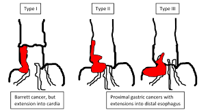 Roughly 1 in 111 adults will develop stomach (gastric) cancer at some point in her lifetime, and the disease is more common among men, according to the american cancer society. Endoscopy Campus Esophagastric Junction Cancers Aeg