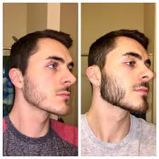 Before you use minoxidil, try a regimen of vitamins and supplements. Minoxidil Beard Before And After Reddit