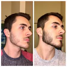 A good way to get used to minoxidil is to start out with 0.5ml and work your. Minoxidil Beard Before And After Reddit