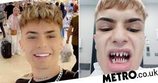 Model says he looks like a 'shark' after £3,000 Turkey teeth surgery