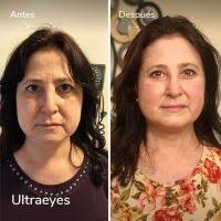 Ultraformer: el novedoso lifting de una sesión que marca tendencia