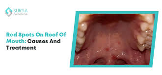 Image result for Mouth ulcers symptoms roof of the mouth