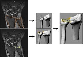 The significant ligaments of the knee joint are as follows:capsular ligament. In Vivo Mechanical Function Of The Distal Radial Ulnar Ligaments During Rotation Of The Wrist Journal Of Hand Surgery