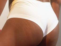 Why Do Stretch Marks Itch Causes Treatment For Skin