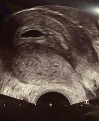 Wann kann man schwanger werden? 5 6 Was Muss Man Im Ultraschall Sehen Forum Schwangerschaft Urbia De