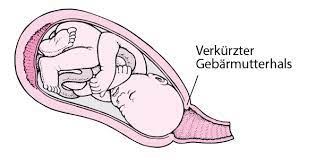 Dabei handelt es sich um regelmäßige kontraktionen der gebärmutter, die ihr kind schlussendlich durch den geburtskanal befördern und den muttermund soweit öffnen, dass der kleine kopf austreten kann. Geburtswehen Gesundheitsprobleme Von Frauen Msd Manual Ausgabe Fur Patienten