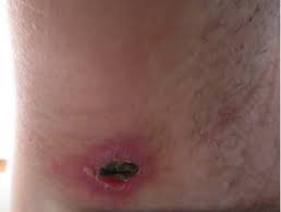Murine typhus is a rickettsial disease. Scrub Typhus Dermnet Nz