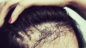 La perte de cheveux diffuse aigue, due au stress. Perte Cheveux Localisee Femme Ce Shampoing Sec Lui Aurait Fait Perdre Les Cheveux Huffpost Quebec Vivre Greffe De Cheveux Chez La Femme From I0 Wp Com