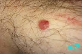 But hearing the words can still be scary. Basal Cell Carcinoma Basalioma Bcc Online Dermatology