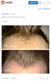 Learn microneedling online become a professional microneedling therapist or simply learn how to perform microneedling. Microneedling Thread Give Me More Hair Open Hair Loss Topics Hair Restoration Network Community For And By Hair Loss Patients