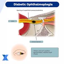 Image result for Pupillary Paralysis