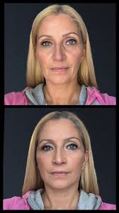 4 weeks post surgery…