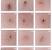 Ingrown Hair Underarm Boil