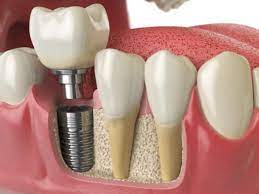 Permanent gold teeth can cost as little as $1,000 up to about $5,000 for a full top and bottom front set. 5 Reasons Why Dental Implants Have Become The Gold Standard In Replacing Teeth Enamel General Cosmetic Dentistry General Dentistry