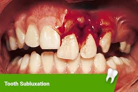 Image result for Tooth Luxation