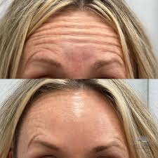We did not find results for: Botox Before And After Photos By Uptown Medical Aesthetics