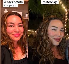 One month post-op body transformation after surgery