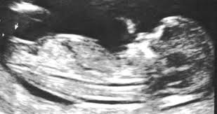 The goal of this study was to characterize the acoustic output of clinical ultrasound instruments, as expressed by ti and mi, during routine. Learning Curve In Determining Fetal Sex By First Trimester Ultrasound Scan Sciencedirect